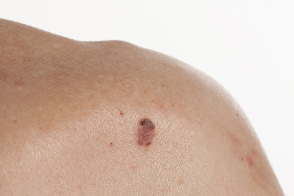 skin cancer cell carcinoma 